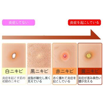 赤ニキビができた時の対処方！池袋/ニギビ/肌管理