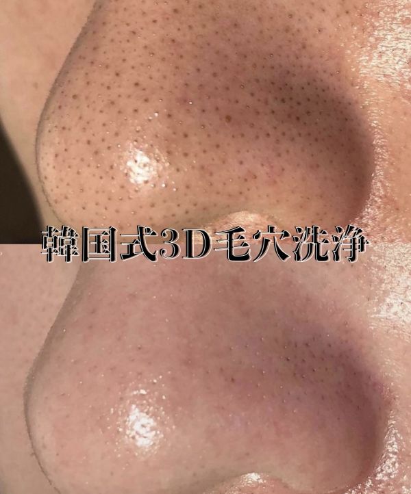 浮き出す→吸引→毛穴引き締め 【韓国式3D毛穴洗浄】