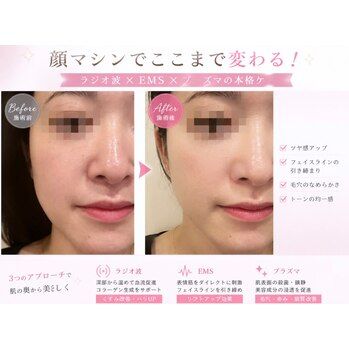 たるみ、毛穴気にしてる方こちらも！ 痩身/池袋