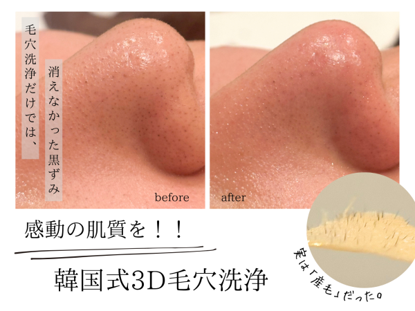 実はそれ汚れじゃなくて毛かも？！ 毛穴/池袋