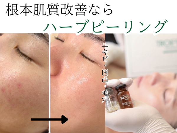肌を整えていくならこれ！ ピーリング/肌荒れ/池袋