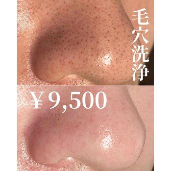 【池袋/毛穴洗浄】毛穴ケアは何回必要？