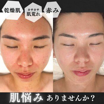 池袋/ベースケアピーリングと毛穴洗浄の違いは？？