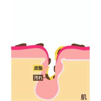 毛穴の中、実は。。。池袋