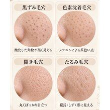 毛穴の種類池袋